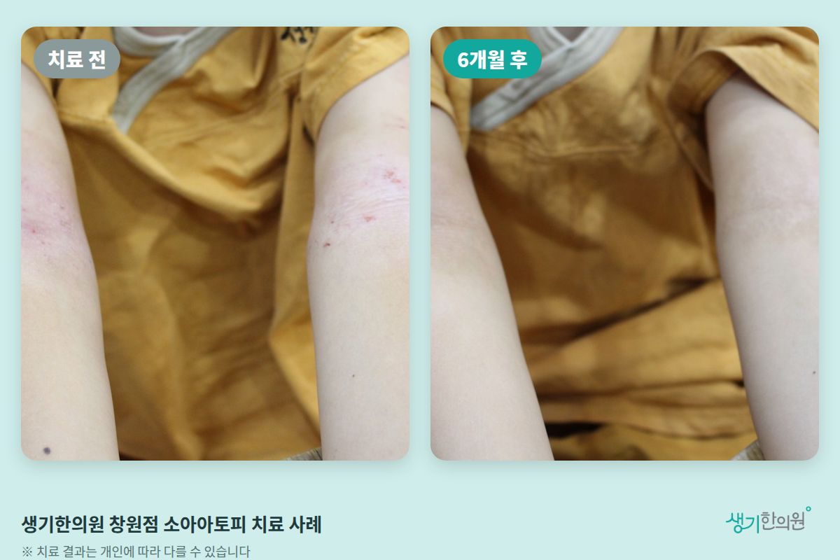 생기한의원 창원점 소아아토피 치료 전과 6개월 후 비교 사진