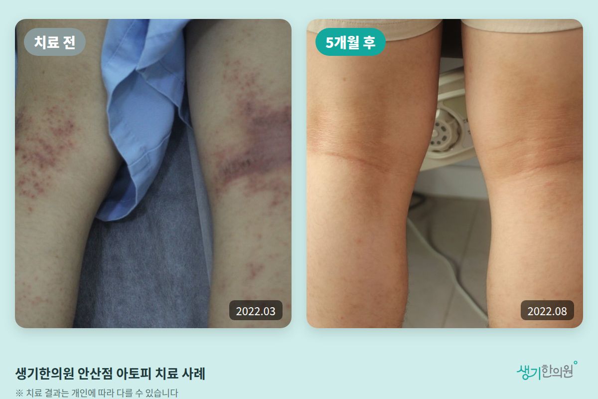 생기한의원 안산점 아토피 치료 전(2022.03)과 5개월 후(2022.08) 비교 사진