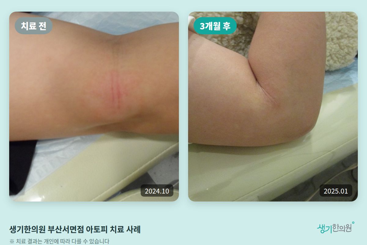 생기한의원 부산서면점 아토피 치료 전(2024.10)과 3개월 후(2025.01) 비교 사진