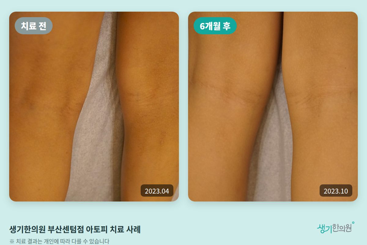 생기한의원 부산센텀점 아토피 치료 전(2023.04)과 6개월 후(2023.10) 비교 사진
