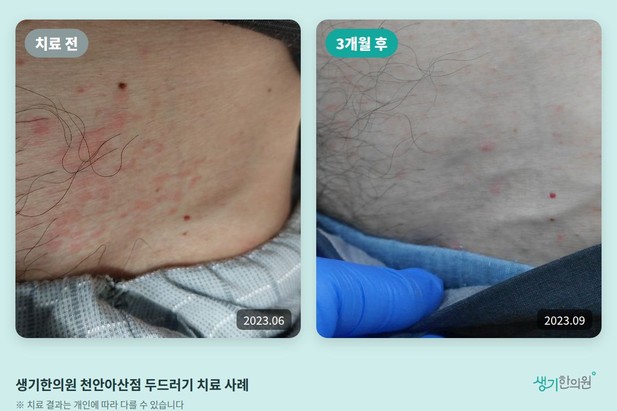 생기한의원 천안아산점 두드러기 치료 전(2023.06)과 3개월 후(2023.09) 비교 사진