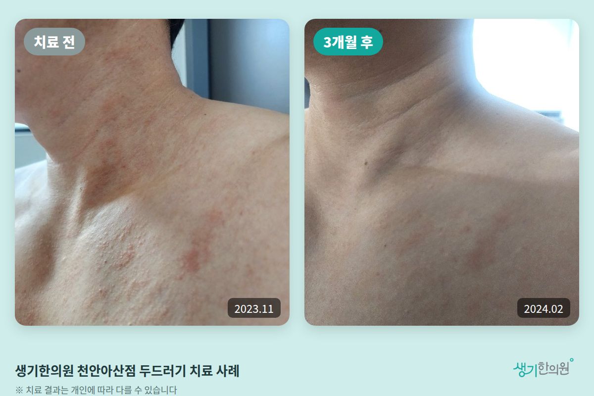 생기한의원 천안아산점 두드러기 치료 전(2023.11)과 3개월 후(2024.02) 비교 사진