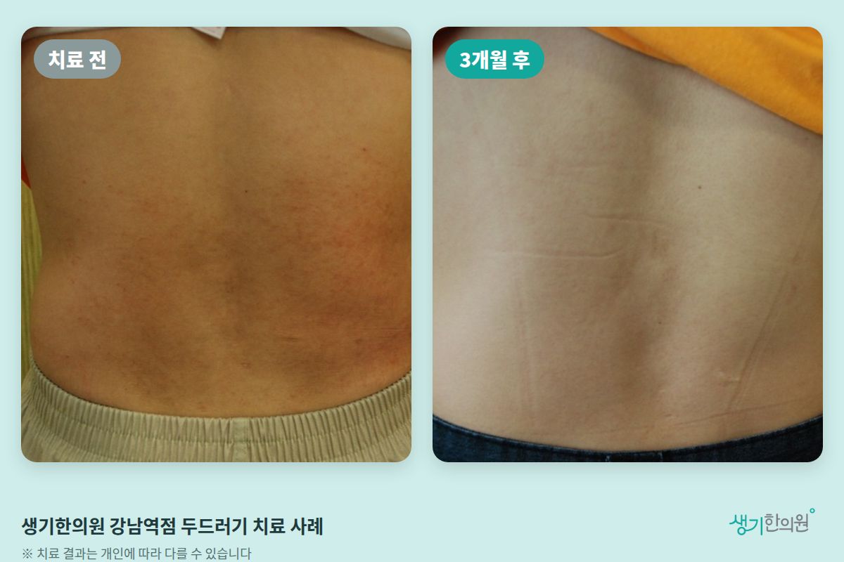 생기한의원 강남역점 두드러기 치료 전과 3개월 후 비교 사진