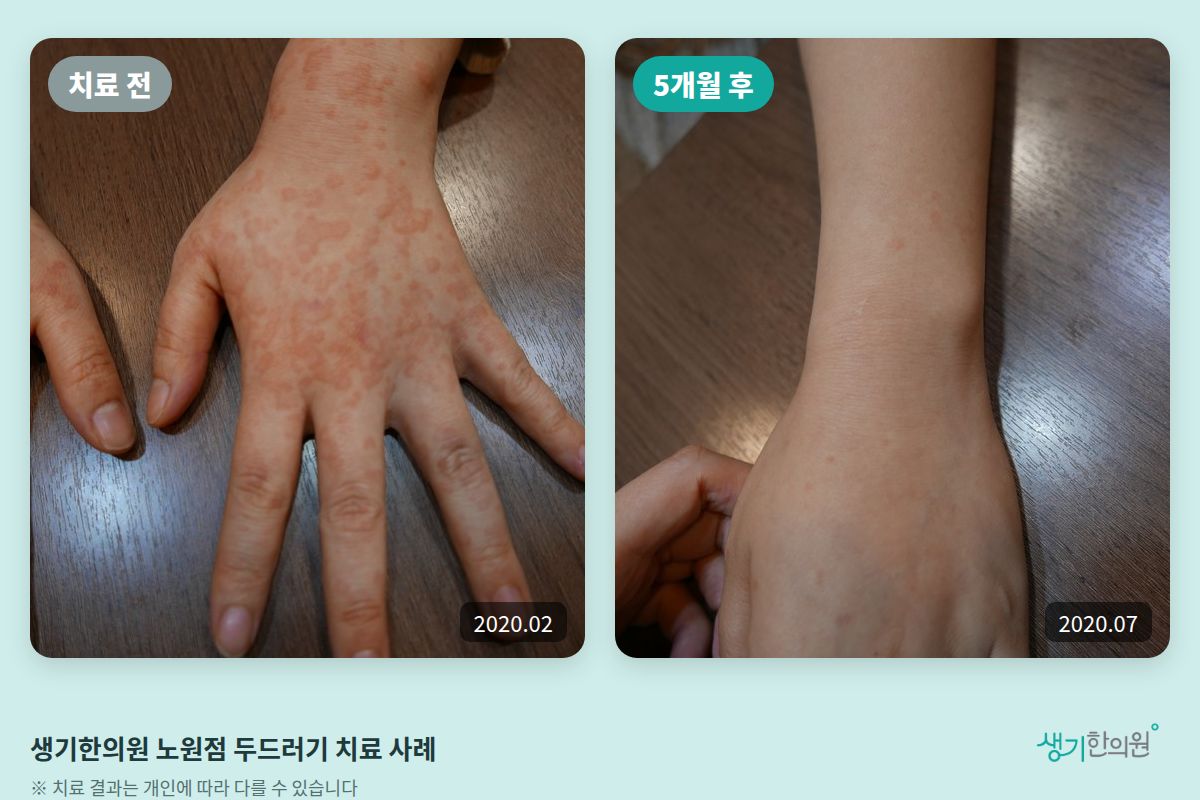 생기한의원 노원점 두드러기 치료 전(2020.02)과 5개월 후(2020.07) 비교 사진