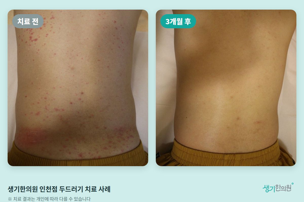 생기한의원 인천점 두드러기 치료 전과 3개월 후 비교 사진