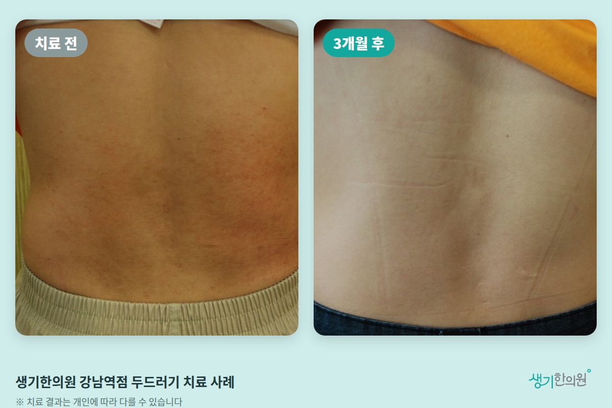 생기한의원 강남역점 두드러기 치료 전과 3개월 후 비교 사진