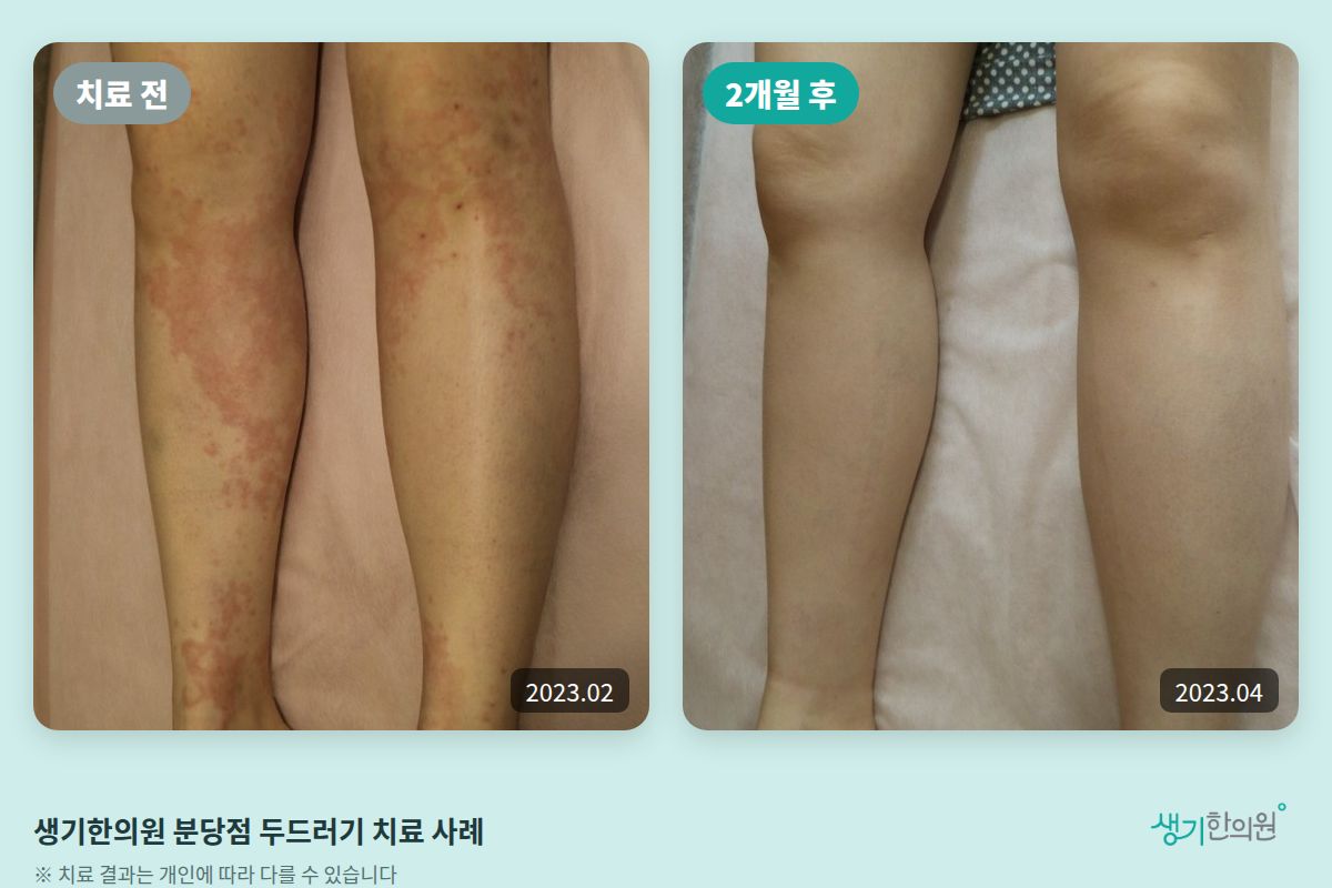 생기한의원 분당점 두드러기 치료 전(2023.02)과 2개월 후(2023.04) 다리 비교 사진
