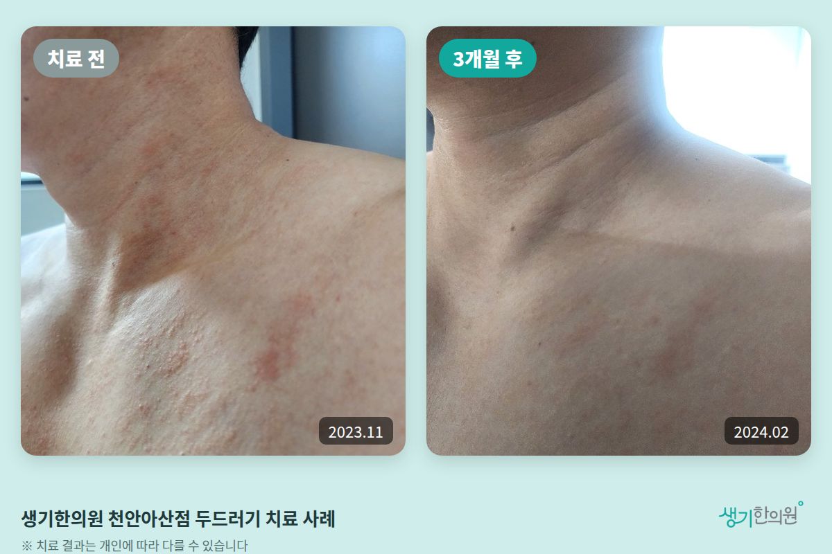 생기한의원 천안아산점 두드러기 치료 전(2023.11)과 3개월 후(2024.02) 비교 사진