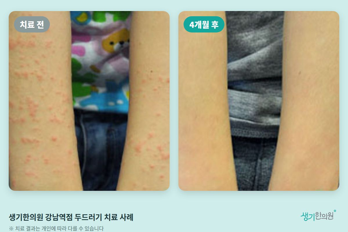 생기한의원 강남역점 두드러기 치료 전과 4개월 후 비교 사진