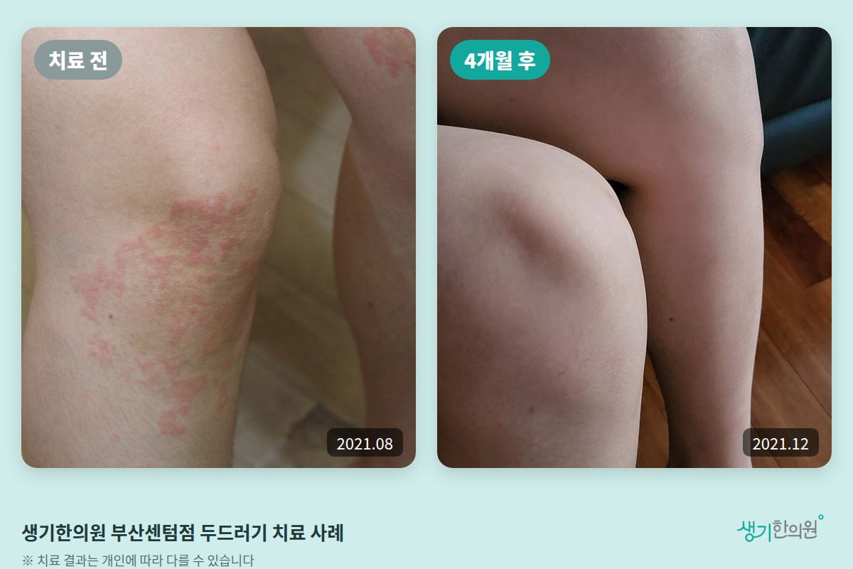 생기한의원 부산센텀점 두드러기 치료 전(2021.08)과 4개월 후(2021.12) 비교 사진