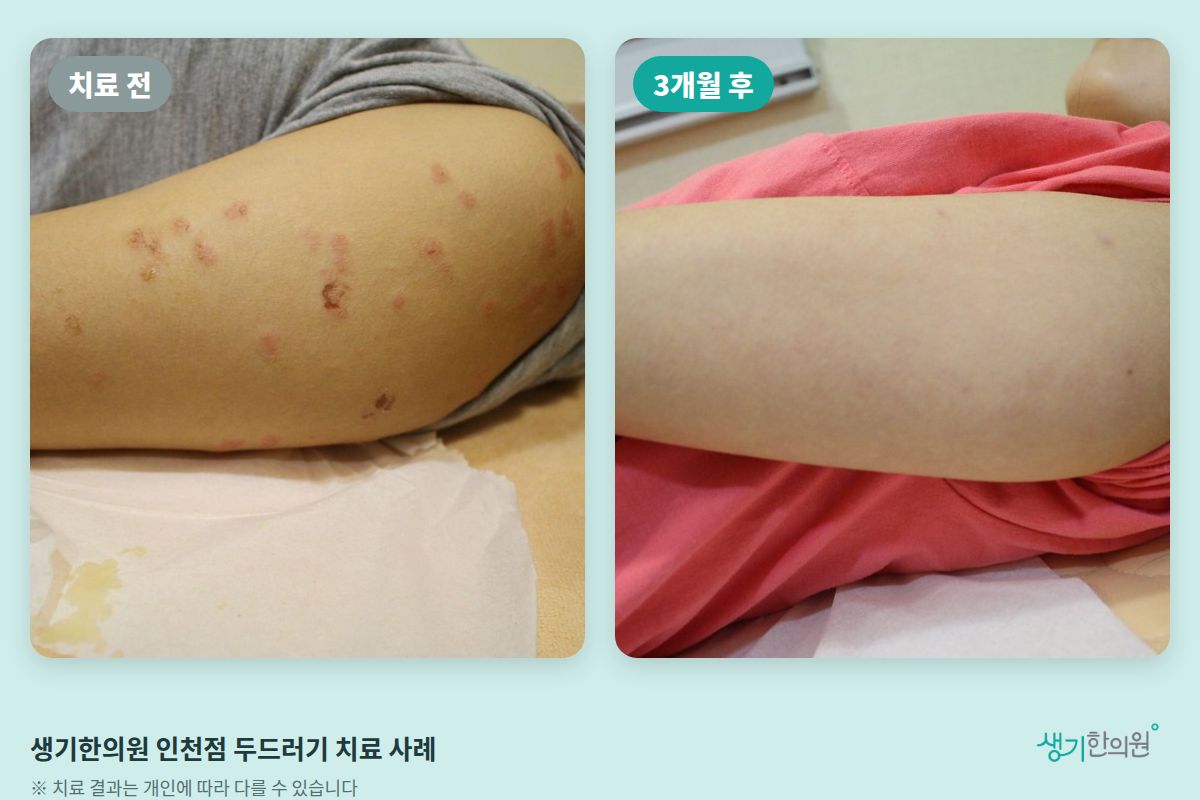 생기한의원 인천점 두드러기 치료 전과 3개월 후 비교 사진