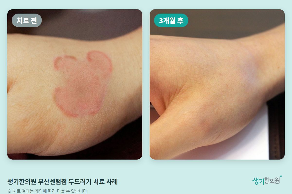 생기한의원 부산센텀점 두드러기 치료 전과 3개월 후 비교 사진