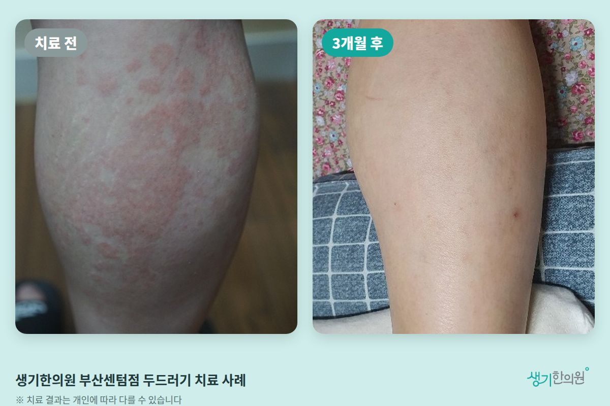 생기한의원 부산센텀점 두드러기 치료 전과 3개월 후 허벅지 비교 사진