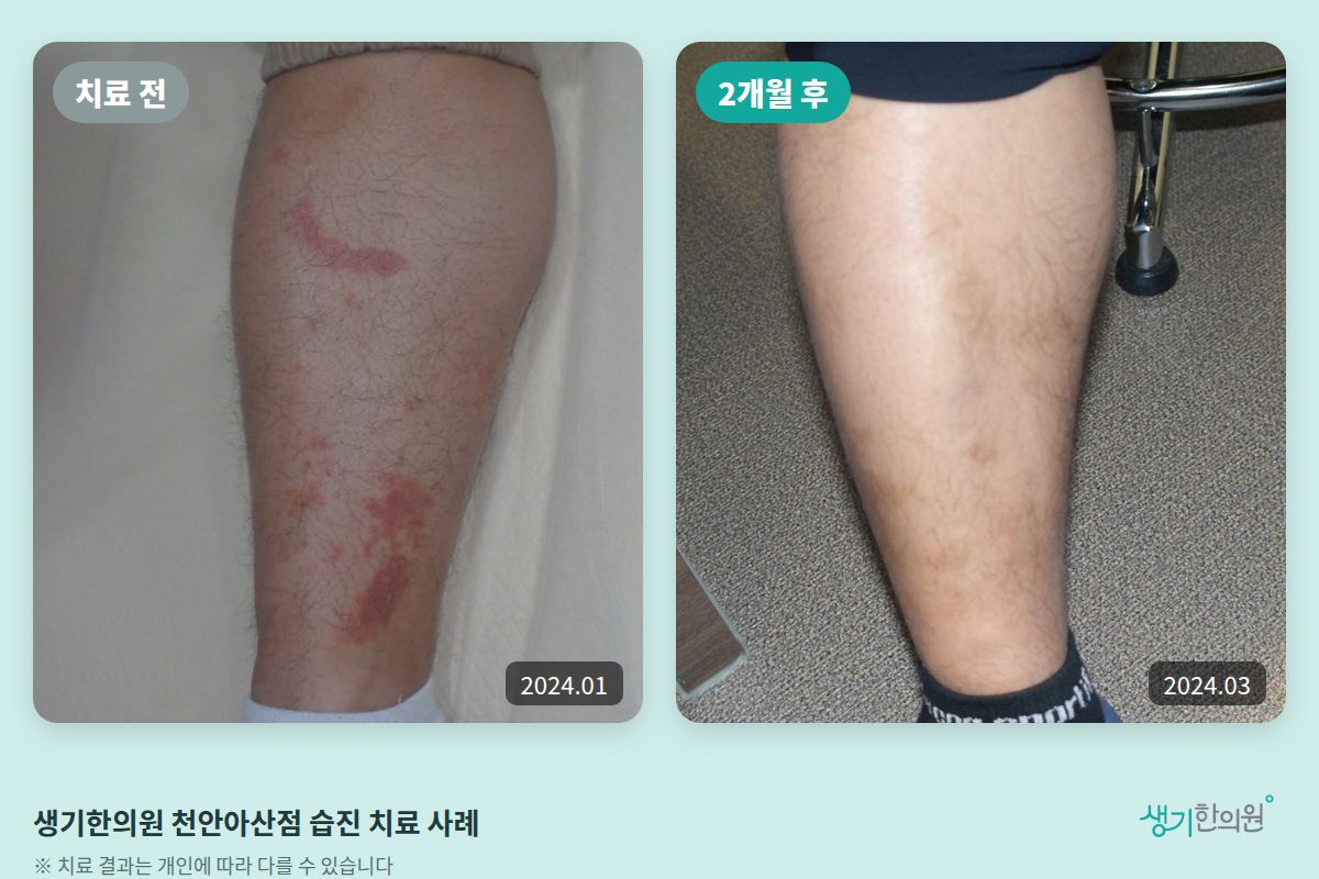 생기한의원 천안아산점 습진 치료 전(2024.01)과 2개월 후(2024.03) 비교 사진