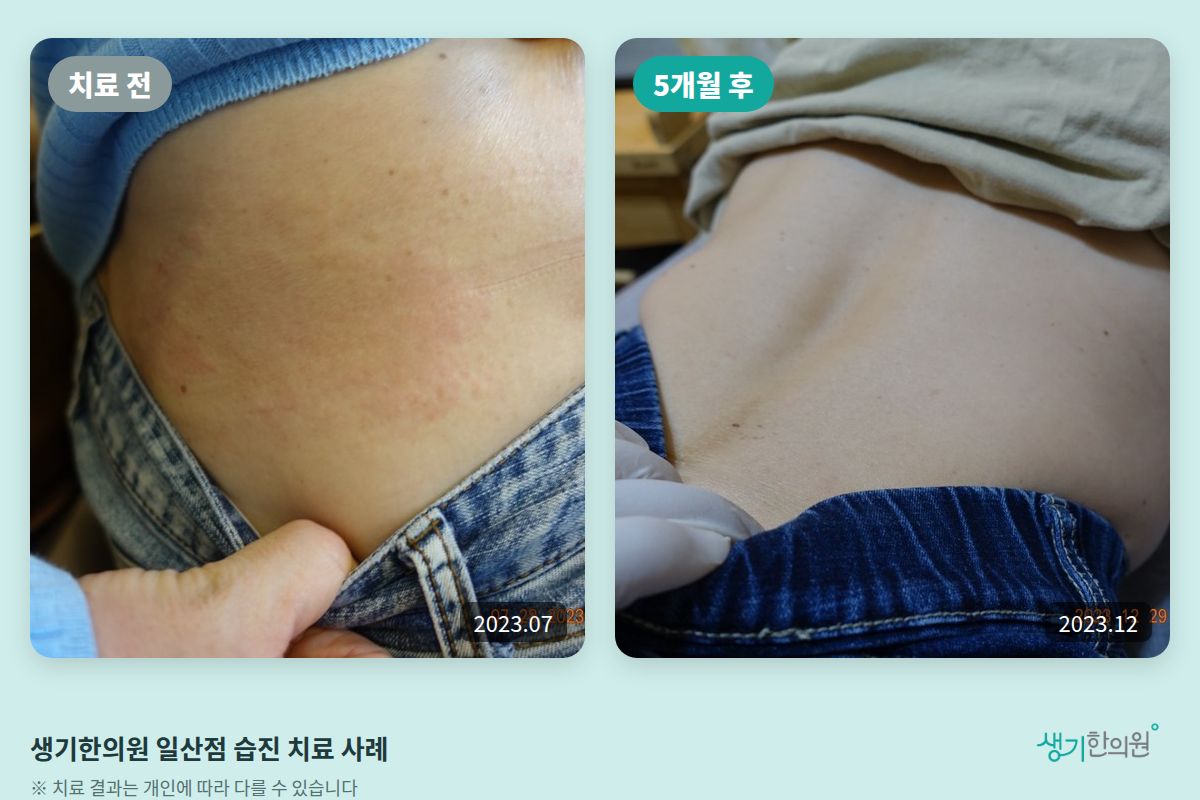 생기한의원 일산점 습진 치료 전(2023.07)과 5개월 후(2023.12) 비교 사진