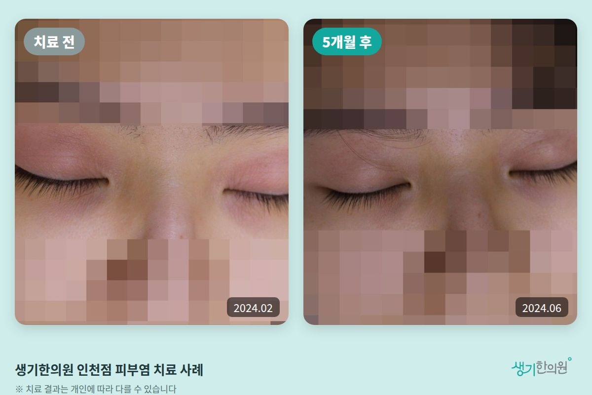 생기한의원 인천점 피부염 치료 전(2024.02)과 5개월 후(2024.06) 비교 사진
