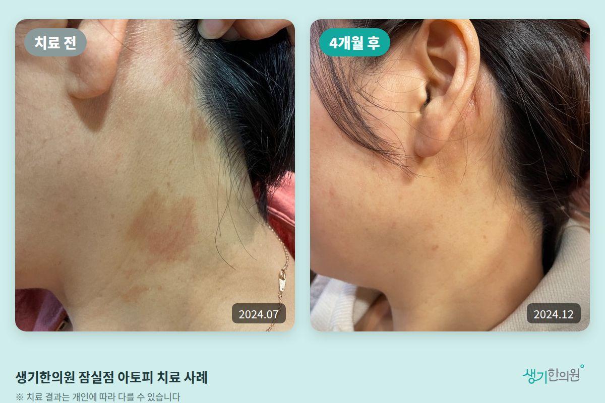 생기한의원 잠실점 아토피 치료 전(2024.07)과 4개월 후(2024.12) 비교 사진