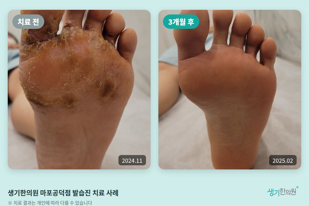 생기한의원 마포공덕점 발습진 치료 전(2024.11)과 3개월 후(2025.02) 비교 사진