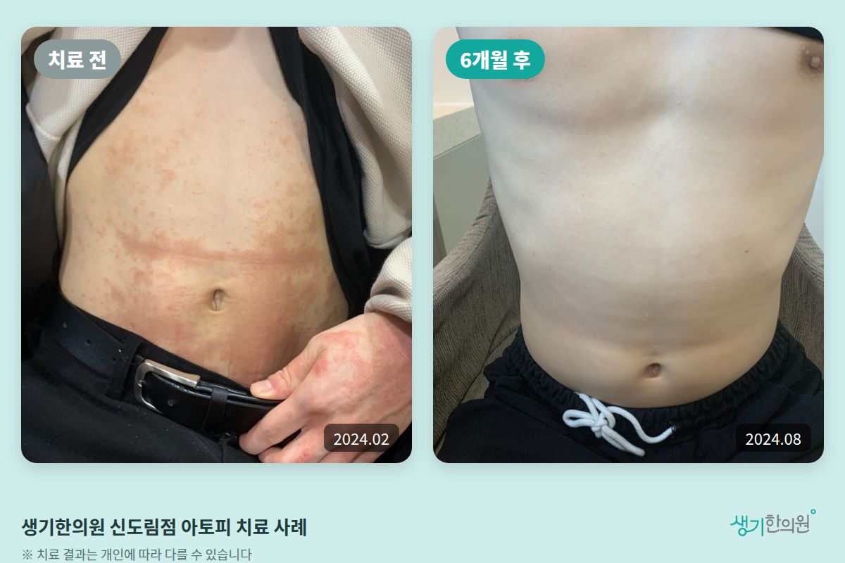 생기한의원 신도림점 아토피 치료 전(2024.02)과 6개월 후(2024.08) 비교 사진