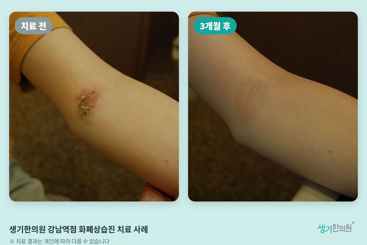 생기한의원 강남역점 화폐상습진 치료 전과 3개월 후 비교 사진
