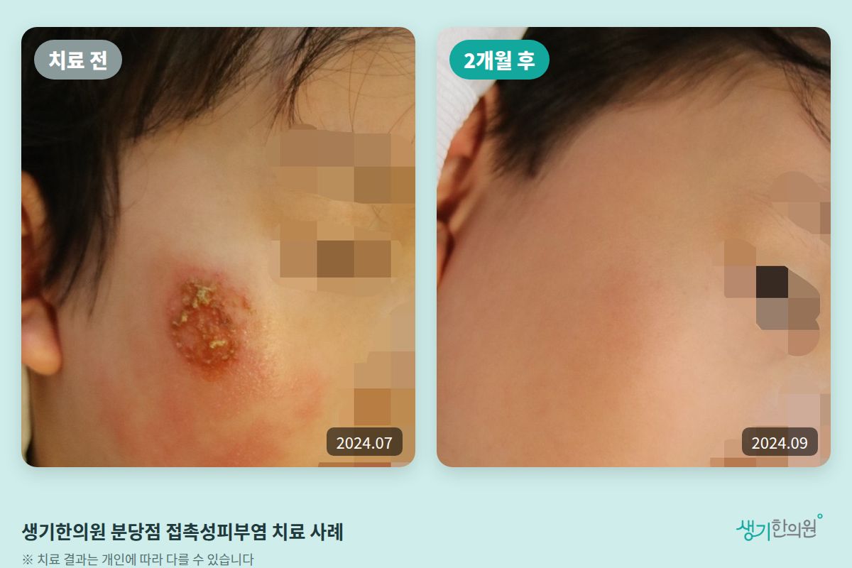 생기한의원 분당점 접촉성피부염 치료 전(2024.07)과 2개월 후(2024.09) 비교 사진