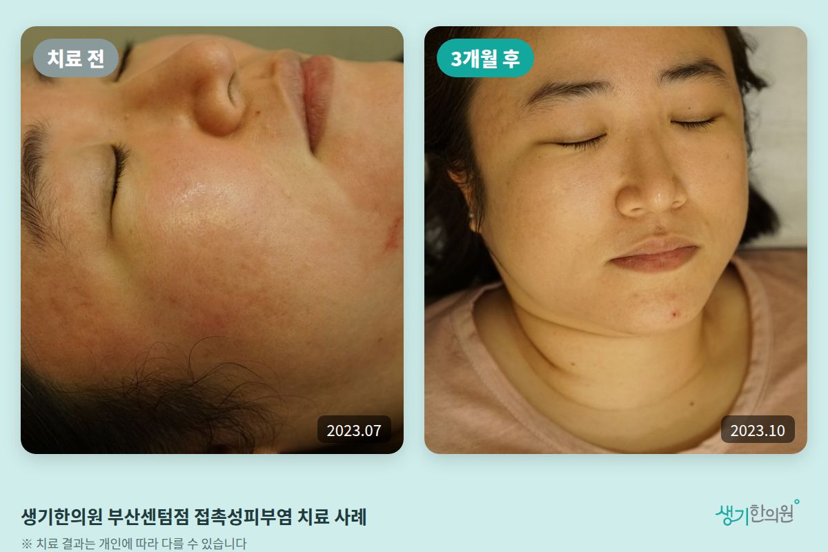 생기한의원 부산센텀점 접촉성피부염 치료 전(2023.07)과 3개월 후(2023.10) 비교 사진