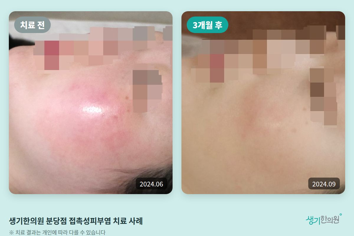 생기한의원 분당점 접촉성피부염 치료 전(2024.06)과 3개월 후(2024.09) 비교 사진