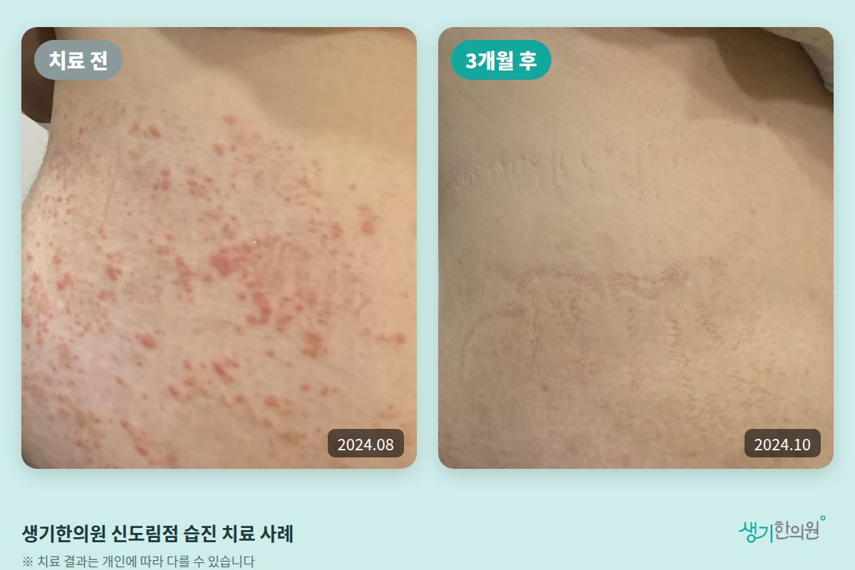 생기한의원 신도림점 습진 치료 전(2024.08)과 3개월 후(2024.10) 비교 사진