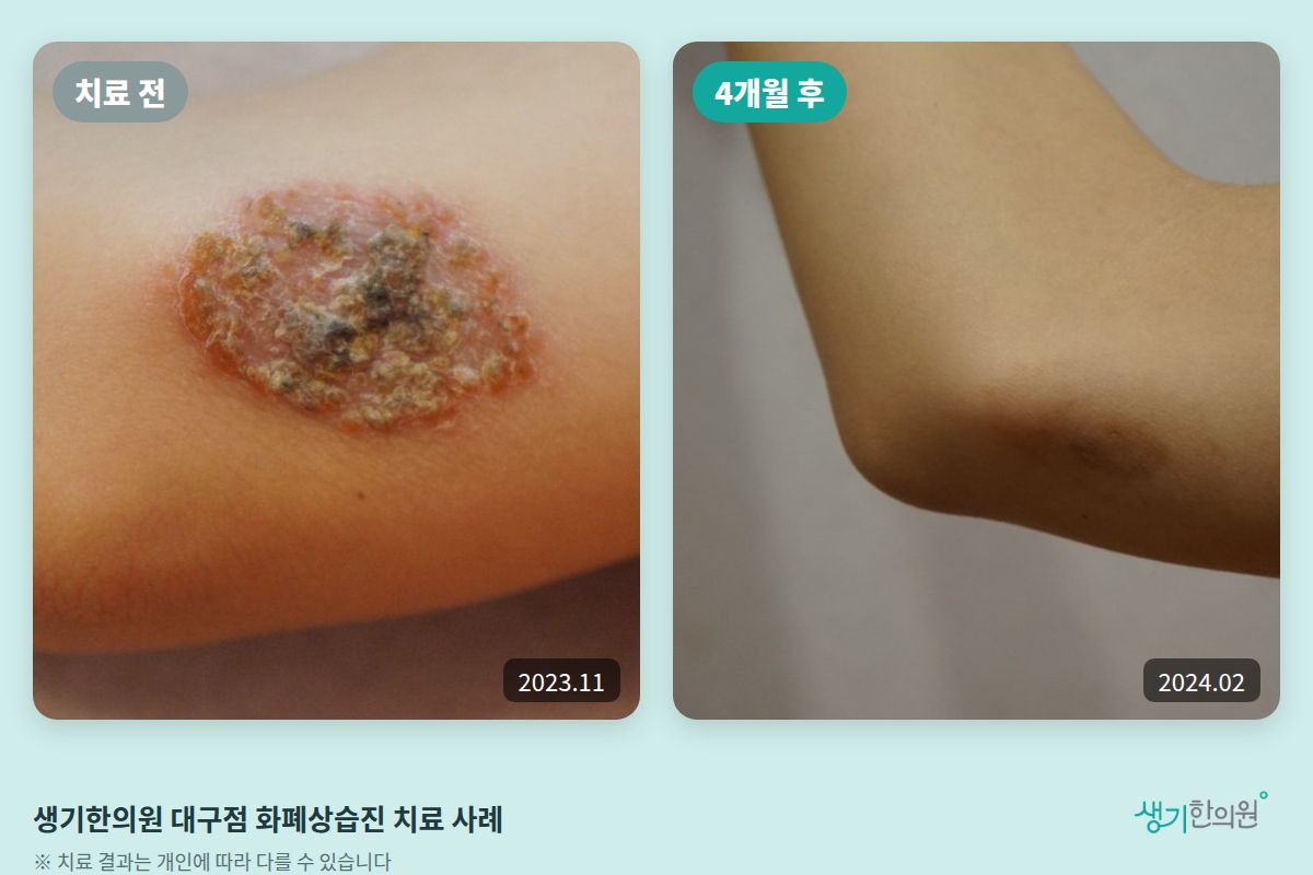 생기한의원 대구점 화폐상습진 치료 전(2023.11)과 4개월 후(2024.02) 비교 사진