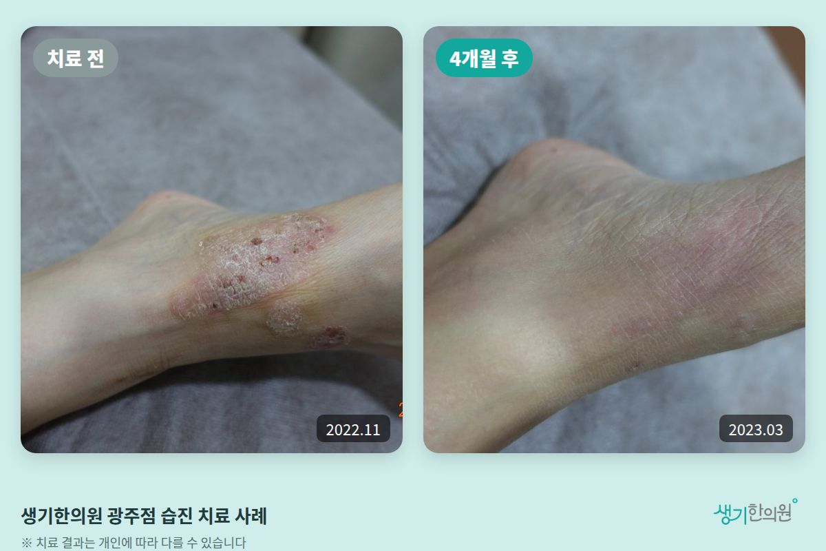생기한의원 광주점 습진 치료 전(2022.11)과 4개월 후(2023.03) 비교 사진