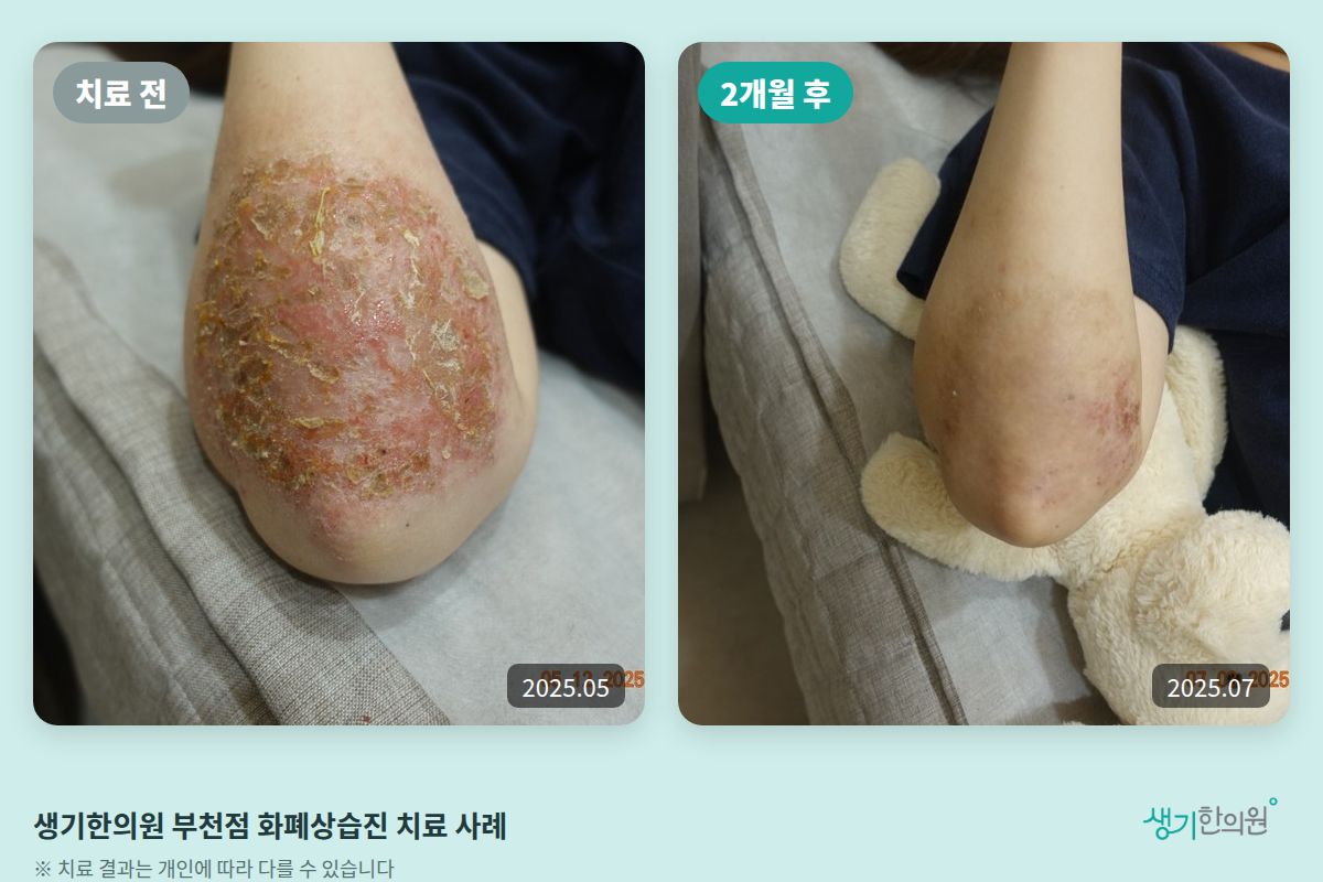 생기한의원 부천점 화폐상습진 치료 전(2025.05)과 2개월 후(2025.07) 비교 사진