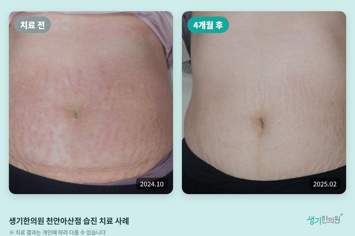 생기한의원 천안아산점 습진 치료 전(2024.10)과 4개월 후(2025.02) 비교 사진