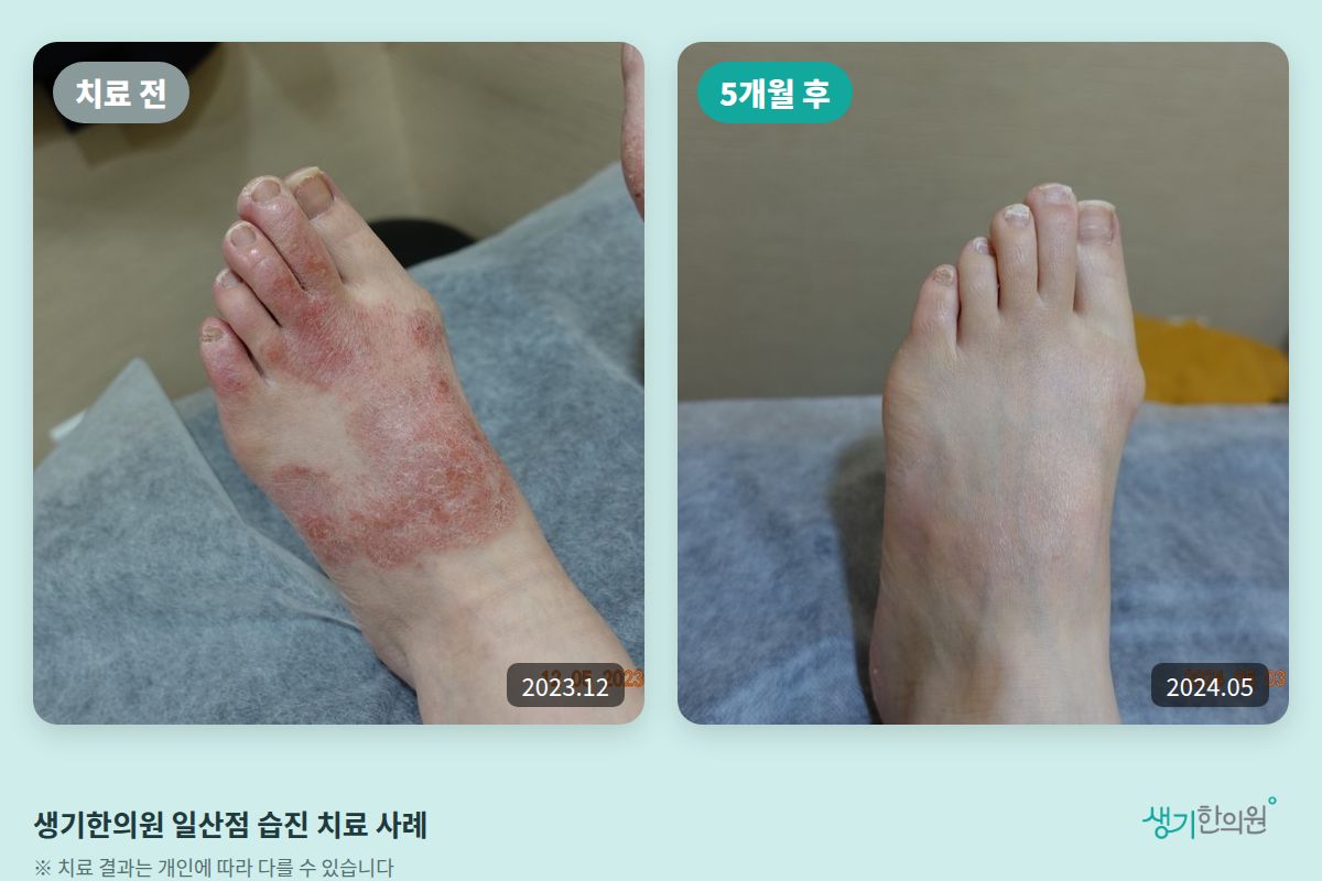 생기한의원 일산점 습진 치료 전(2023.12)과 5개월 후(2024.05) 비교 사진