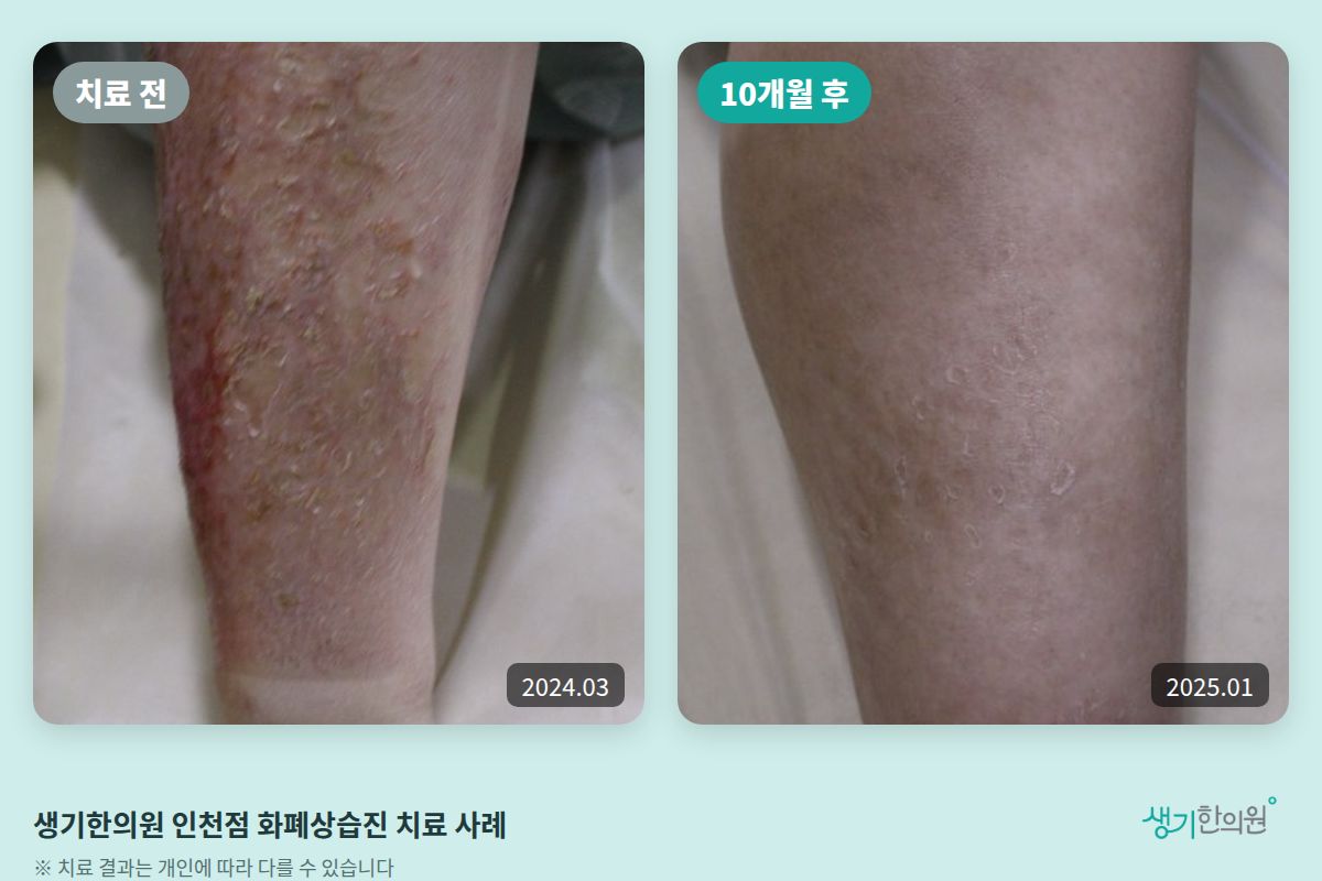 생기한의원 인천점 화폐상습진 치료 전(2024.03)과 10개월 후(2025.01) 비교 사진