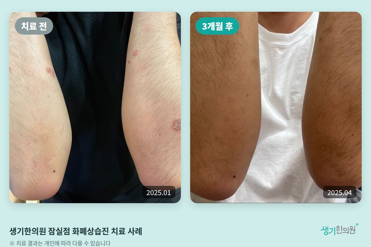 생기한의원 잠실점 화폐상습진 치료 전(2025.01)과 3개월 후(2025.04) 비교 사진