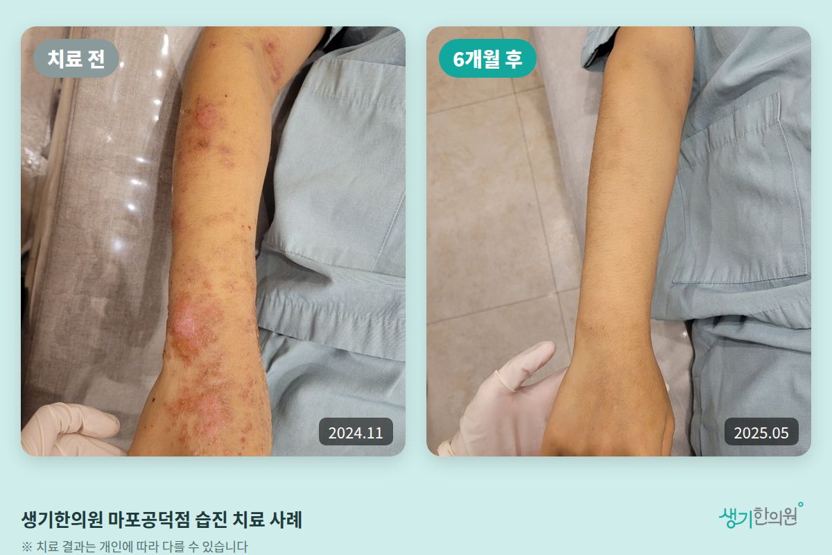 생기한의원 마포공덕점 습진 치료 전(2024.11)과 6개월 후(2025.05) 비교 사진