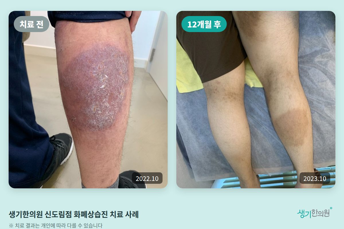 생기한의원 신도림점 화폐상습진 치료 전(2022.10)과 12개월 후(2023.10) 비교 사진