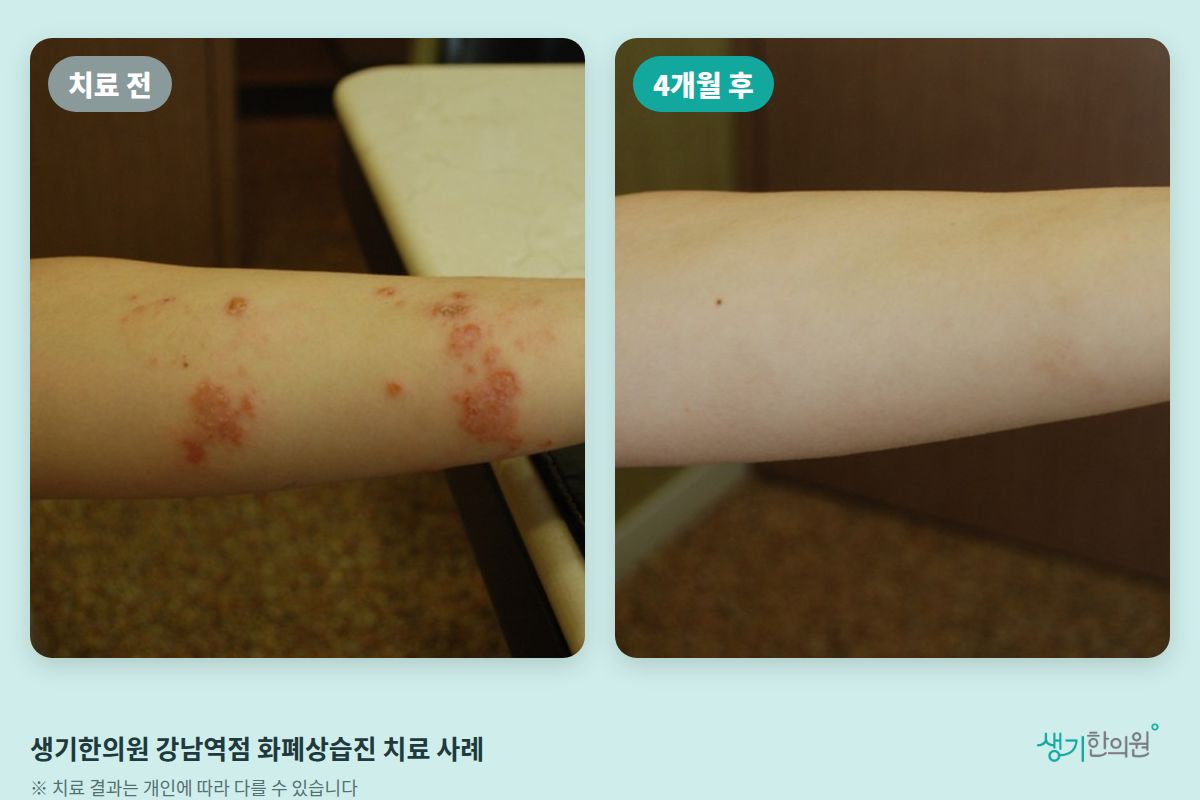 생기한의원 강남역점 화폐상습진 치료 전과 4개월 후 비교 사진