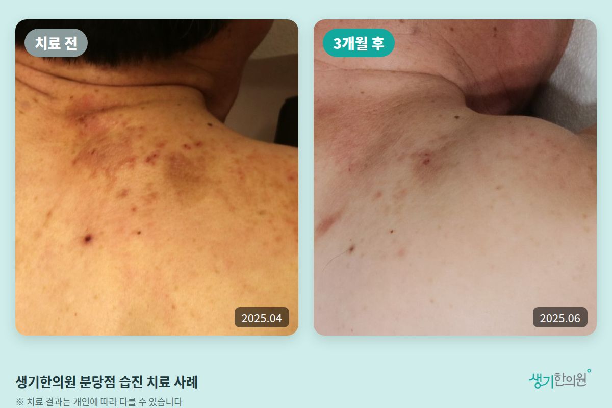 생기한의원 분당점 습진 치료 전(2025.04)과 3개월 후(2025.06) 비교 사진