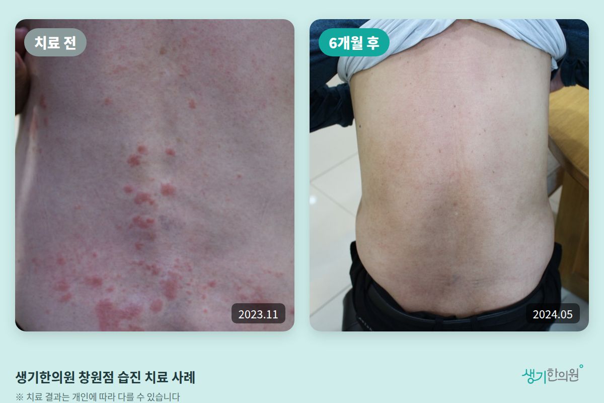생기한의원 창원점 습진 치료 전(2023.11)과 6개월 후(2024.05) 비교 사진