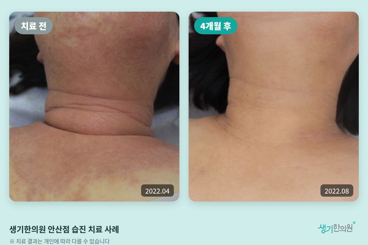 생기한의원 안산점 습진 치료 전(2022.04)과 4개월 후(2022.08) 비교 사진