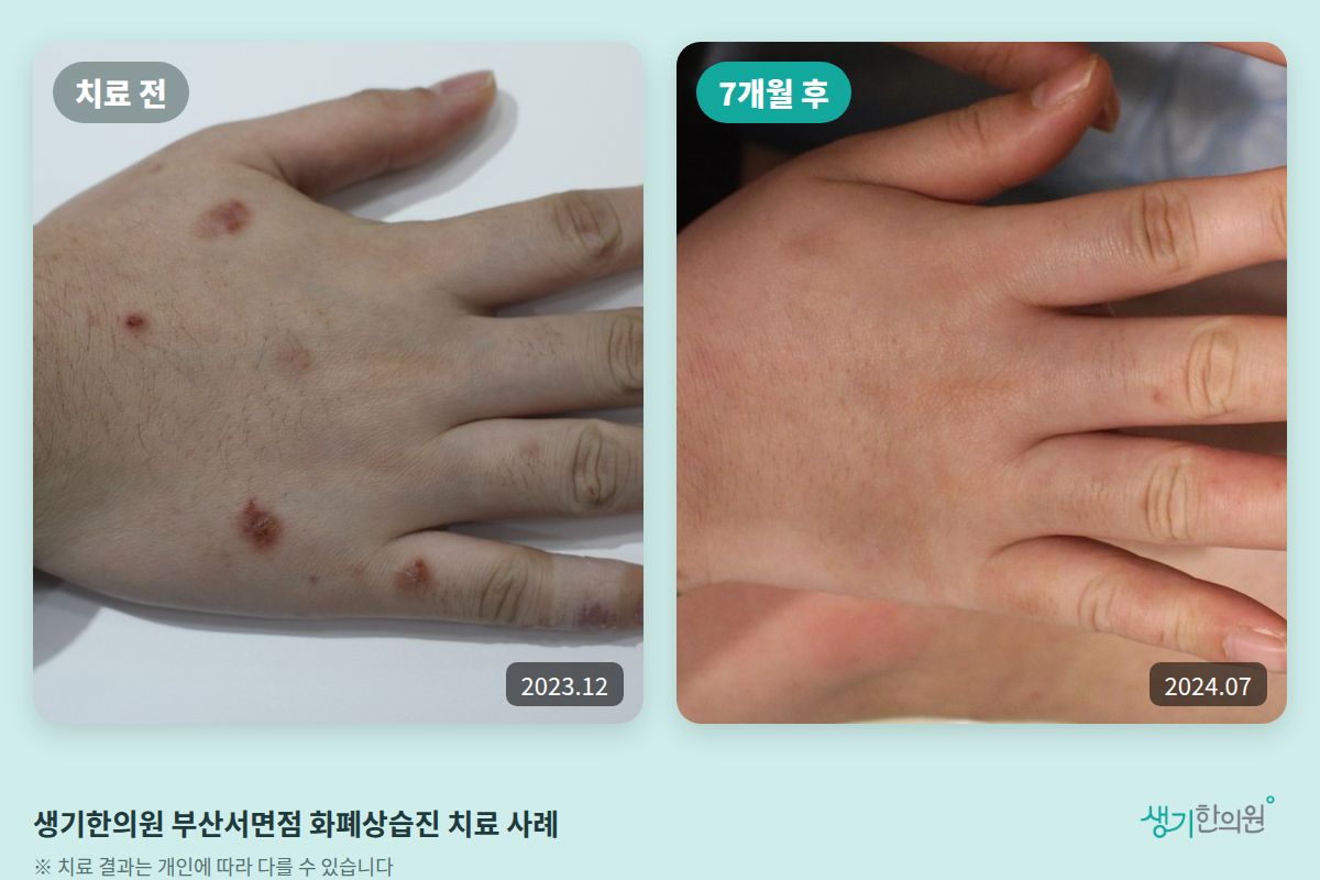 생기한의원 부산서면점 화폐상습진 치료 전(2023.12)과 7개월 후(2024.07) 비교 사진