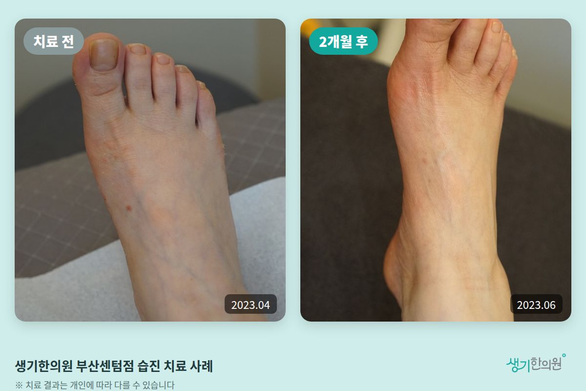 생기한의원 부산센텀점 습진 치료 전(2023.04)과 2개월 후(2023.06) 비교 사진