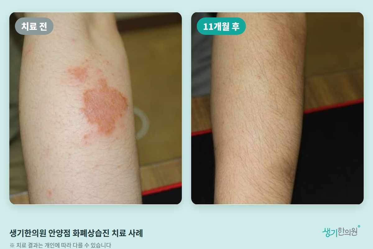 생기한의원 안양점 화폐상습진 치료 전과 11개월 후 비교 사진