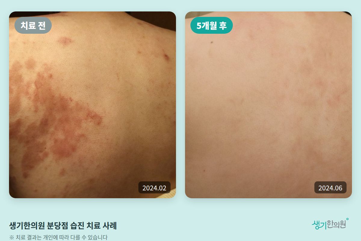 생기한의원 분당점 습진 치료 전(2024.02)과 5개월 후(2024.06) 비교 사진