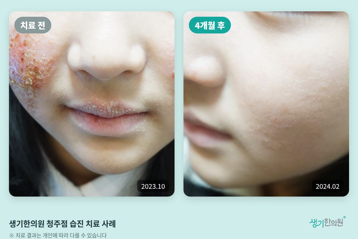 생기한의원 청주점 습진 치료 전(2023.10)과 4개월 후(2024.02) 볼 부위 비교 사진