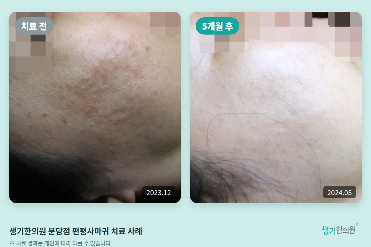 생기한의원 분당점 편평사마귀 치료 전(2023.12)과 5개월 후(2024.05) 비교 사진