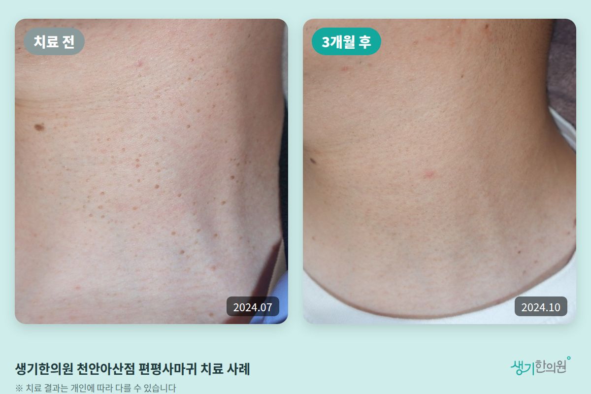 생기한의원 천안아산점 편평사마귀 치료 전(2024.07)과 3개월 후(2024.10) 비교 사진