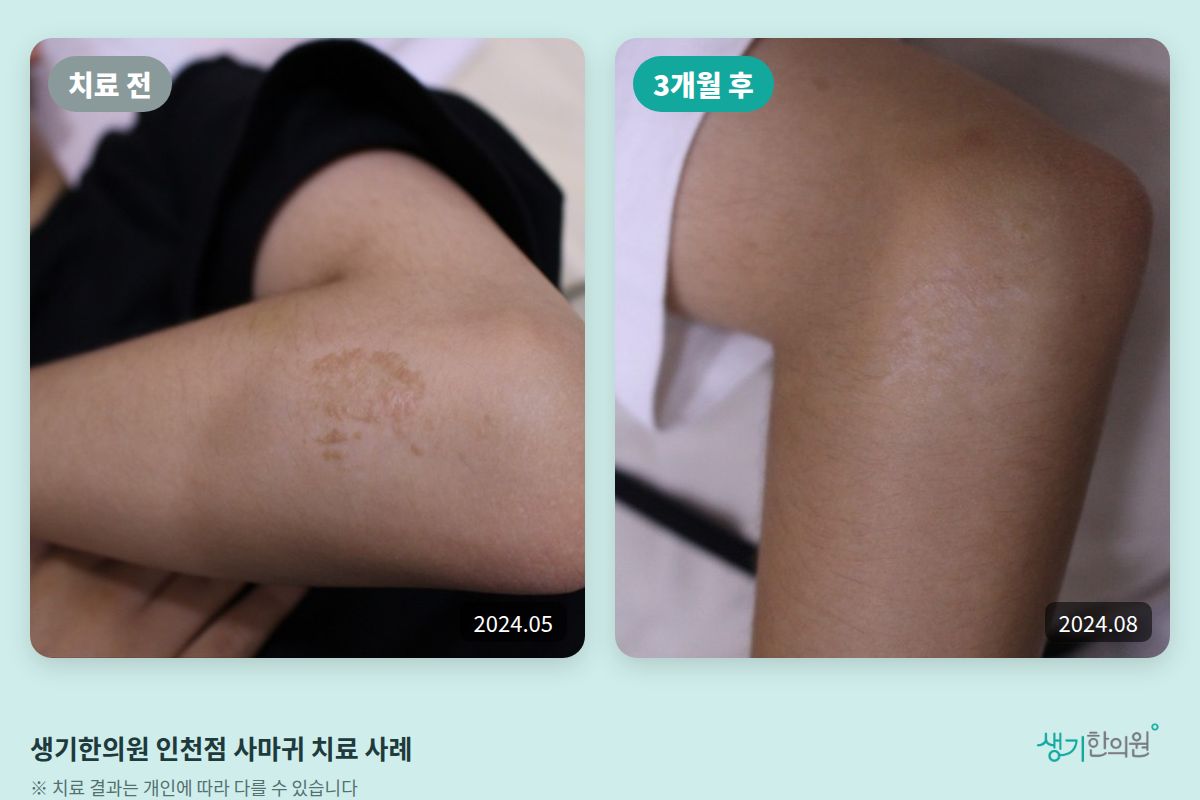생기한의원 인천점 사마귀 치료 전(2024.05)과 3개월 후(2024.08) 비교 사진