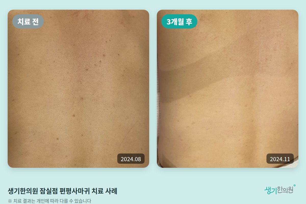 생기한의원 잠실점 편평사마귀 치료 전(2024.08)과 3개월 후(2024.11) 비교 사진